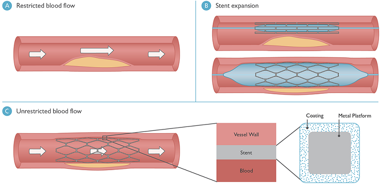 图显示了受限的血液流动，血管中的支架以及由于使用支架而导致的不受限制的血流