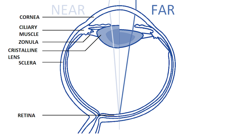 显示人眼解剖结构如何影响近和远视力的示意图示意图