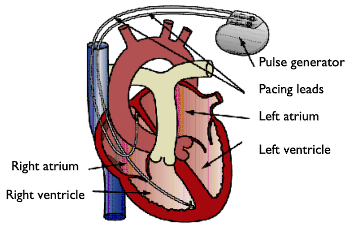 具有两个起搏器电极对的心脏示意图。
